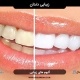 سابلیمینال دندان